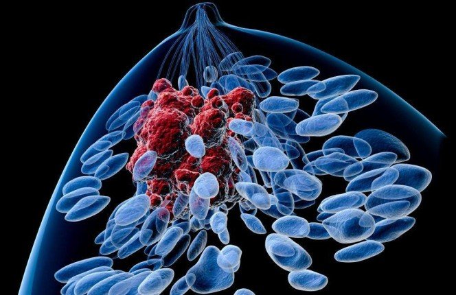 اختراق علمي يكشف سببًا جديدًا لسرطان الثدي الثلاثي السلبي لدى الشابات		 – الخليجي نت