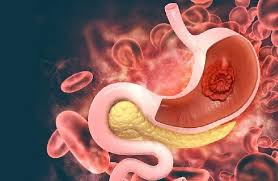 العامل الرئيسي لتطور سرطان المعدة		 – الخليجي نت