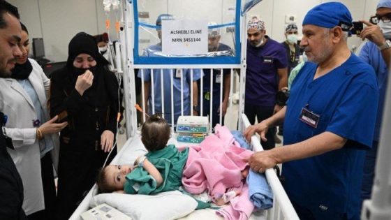 نجاح عملية فصل التوأم السيامي السوري «سيلين وإيلين» – الخليجي نت