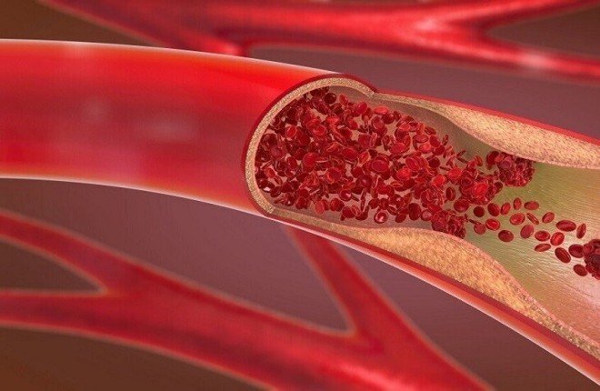 “تصلب الشرايين” المرض الصامت الذي يهدد القلب والدماغ		 – الخليجي نت