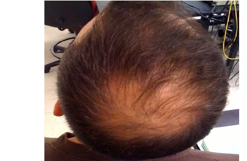 طبيبة تكشف أسباب تساقط الشعر وتحذر من العلاج الذاتي		 – الخليجي نت