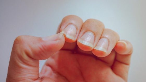 هلالات الأظافر.. إشارات خفية من جسدك عن صحتك – الخليجي نت