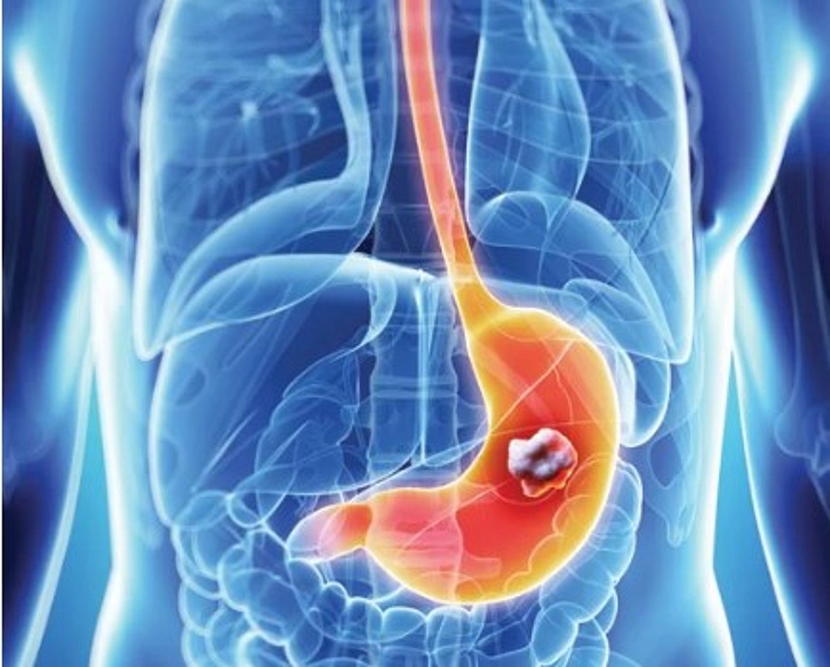 استشاري: 4 نصائح طبية للوقاية من سرطان المعدة		 – الخليجي نت