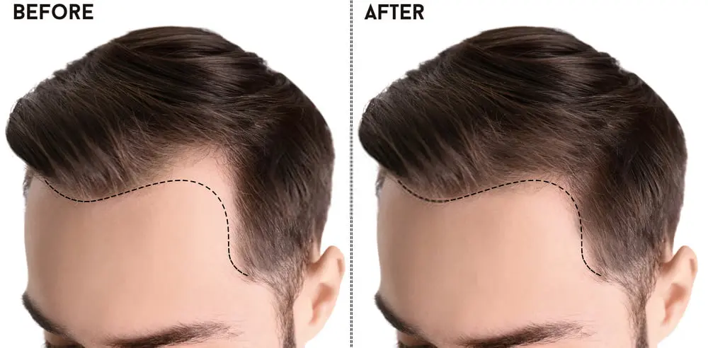 زراعة الشعر في تركيا: الحل الأمثل لاستعادة كثافة الشعر		 – الخليجي نت