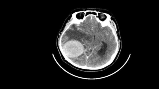 دراسة صادمة تكشف.. القلق والدوار قد يكونان إنذارًا مبكرًا لأورام الدماغ! – الخليجي نت