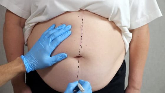 عملية شفط الدهون: الحل المثالي لنحت الجسم واستعادة الثقة – الخليجي نت