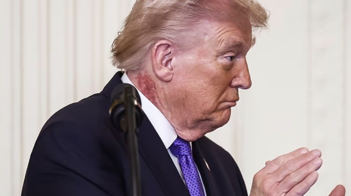 سر البقعة الحمراء في رقبة ترامب.. جدري أم هربس أم سرطان؟
                             – الخليجي نت