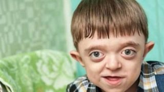 ما هو مرض متلازمة كروزون (Crouzon Syndrome)؟، الأعراض وطرق العلاج
                             – الخليجي نت