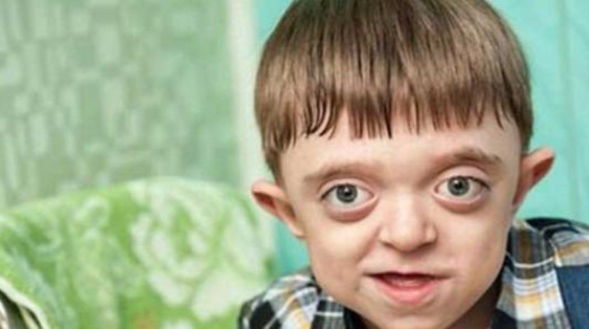 ما هو مرض متلازمة كروزون (Crouzon Syndrome)؟، الأعراض وطرق العلاج
– الخليجي نت