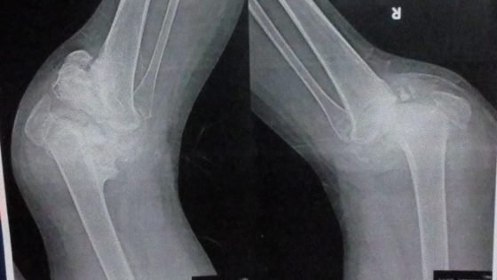 بين شبح البتر وأمل السفر.. “دعاء” فتاة يفتت “شاركوت” عظامها (خاص) – الخليجي نت