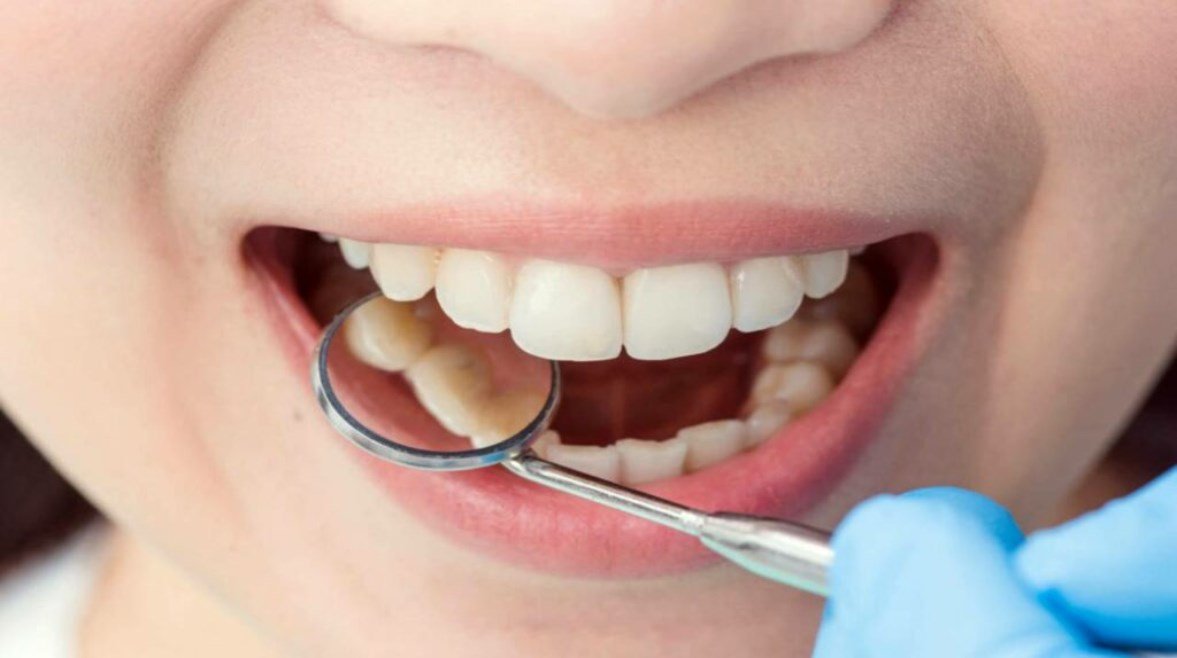 علاج تسوس الأسنان في 5 طرق.. متى يجب زيارة الطبيب؟ – الخليجي نت
