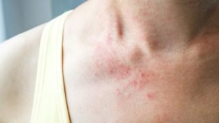مع اشتداد حر الصيف.. دليل العلاج المنزلي للطفح الحراري الشائك
                             – الخليجي نت
