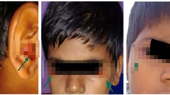ضريبة الضغط الدراسي.. طفل ينزف دما من عينيه وأذنيه بسبب الامتحانات – الخليجي نت