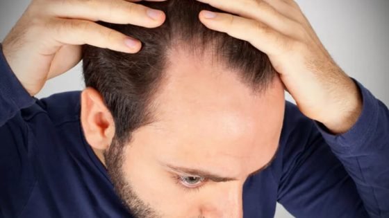 فوائد الصلع غير المتوقعة.. هل يحمي تساقط الشعر من الإصابة بسرطان البروستاتا؟ – الخليجي نت